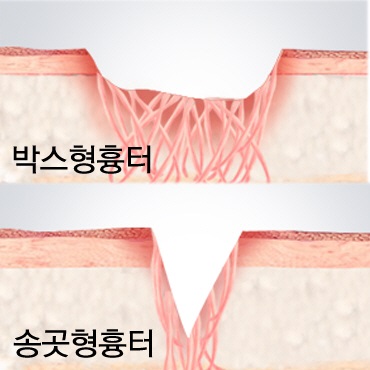 피부 겉과 속 동시 재생으로 여드름흉터 치료방법 알아보자