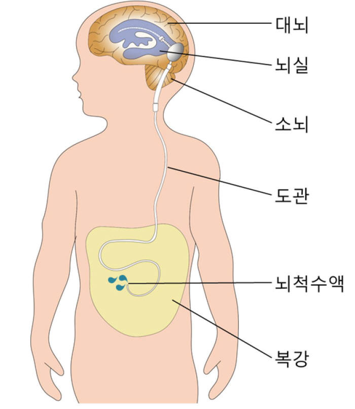 뇌척수액의 흐름을 복강으로 이어주는 션트수술
