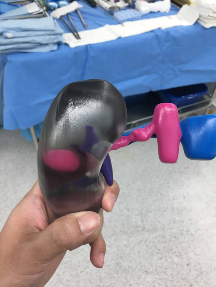 환자 신장을 3D 프린팅으로 구현했다. 가운데 빨간 부분이 종양 부위다.