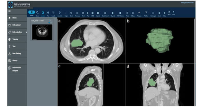 폐암PET CT 분리 및 2D, 3D 영상(자료: 건강보험심사평가원)