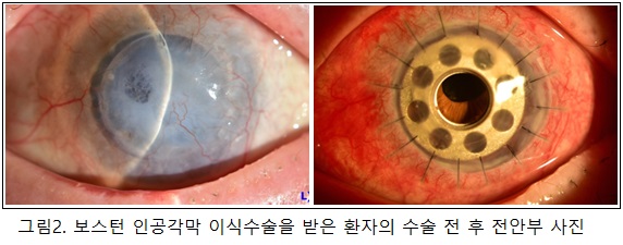 보스턴 인공각막 이식수술을 받은 환자의 수술 전 후 전안부 사진