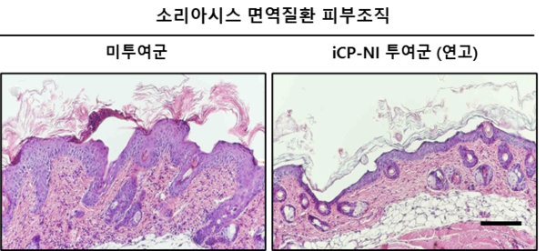 [사진설명: 자가면역질환 소리아시스 (건선) 질병모델에서 과도한 염증반응에 의해 비정상적으로 각질층이 붕괴되고 경화되어 불규칙하게 파괴된 피부조직 (왼쪽)을 iCP-NI가 정상화시킴 (오른쪽)]