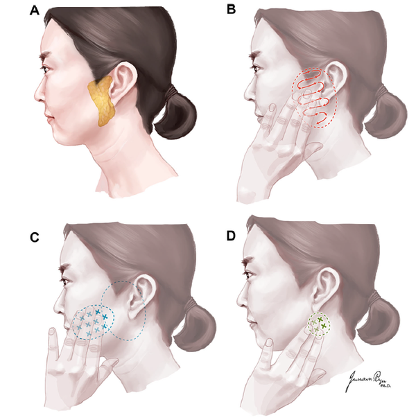 삼성서울병원은 이하선암 자가검진법. 이하선이 위치한 귀 주변부와 입, 귀, 턱 등을 만져서 2주 이상 지속되는 덩어리를 발견하면 전문의 진료를 받아야 한다고 권고했다.