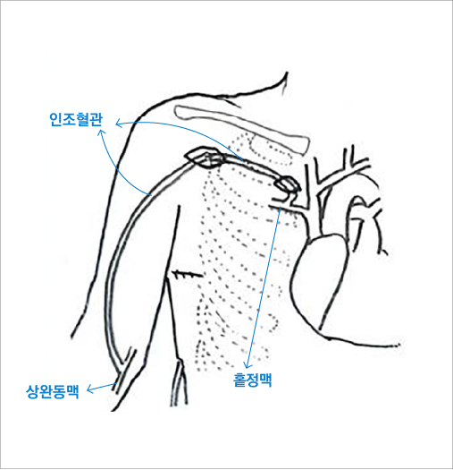 상완동맥-홑정맥 동정맥루 모식도. 사진/순천향대서울병원