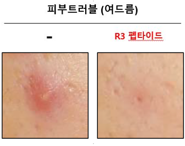 피부트러블 (여드름)이 R3 펩타이드가 첨가된 얼굴로션을 발랐을 시 개선되는 효능을 보임. 사진/셀리버리 리빙앤헬스