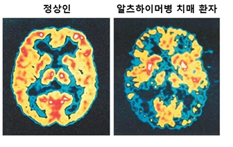 그림설명: 양전자방출단층촬영술 (positron emission tomography: PET)을 통해 정상인 및 알츠하이머병 치매환자의 뇌를 비교함. (출처: Alzheimer’s Disease Education And Referral Center, National Institute On Aging). 사진/셀리버리