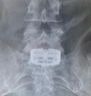 전방 경유 척추 유합술용 높이확장형 케이지 ‘패스락-TA’를 삽입한 첫 수술 사진. 사진/엘앤케이바이오메드