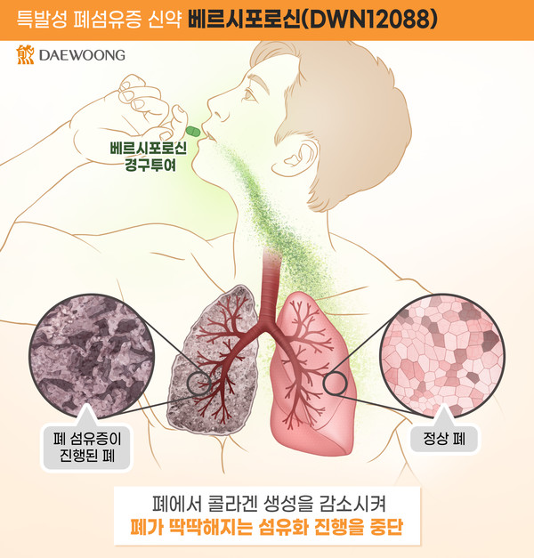 폐섬유증 치료제 베르시포로신 작용 기전. 사진/대웅제약
