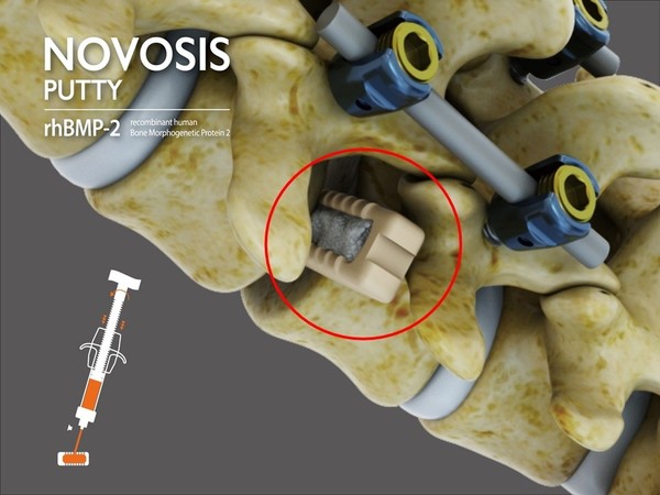 척추 유합술에 노보시스 퍼티(NOVOSIS PUTTY)를 적용한 모습. 사진/시지바이오